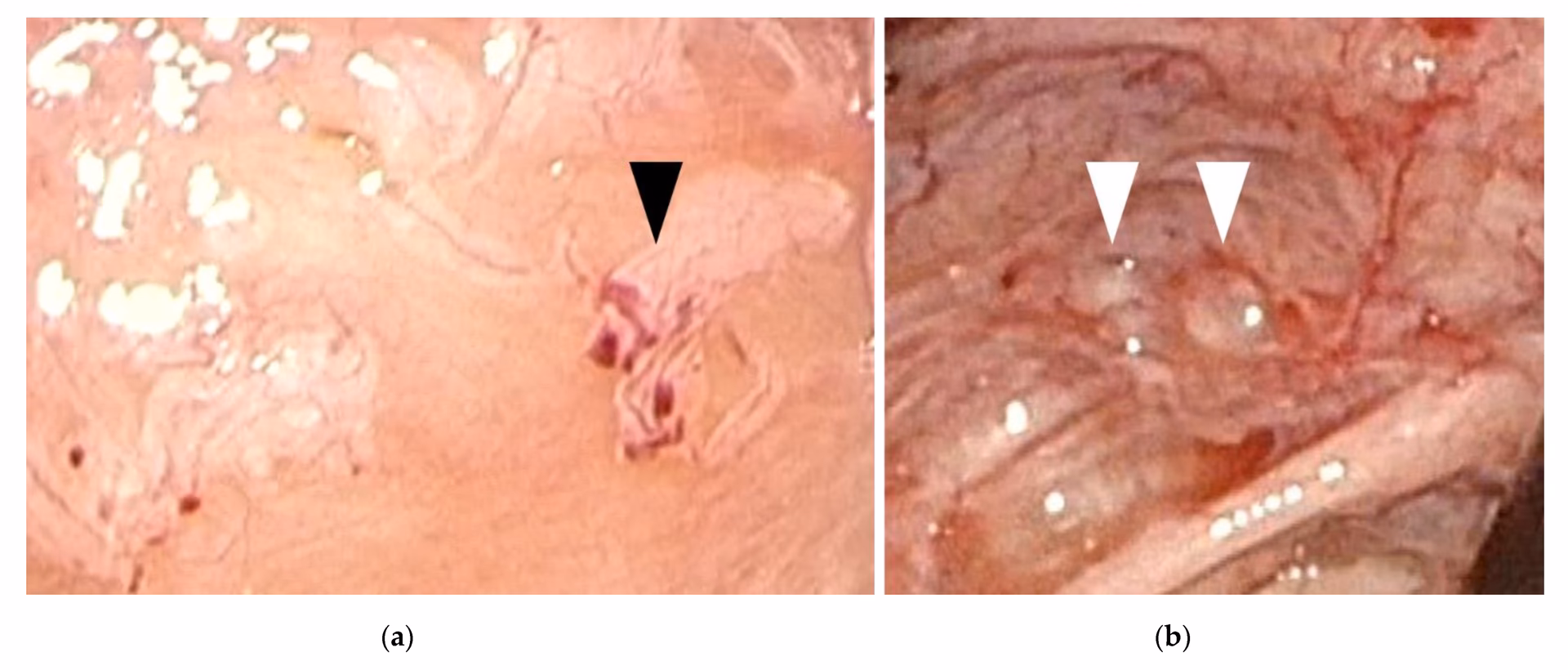 Do teenagers get endometriosis?