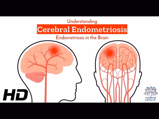 What is the pathogenesis of endometriosis of the brain?