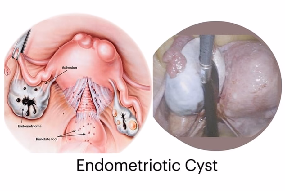 Is a burst cyst a sign of endometriosis?