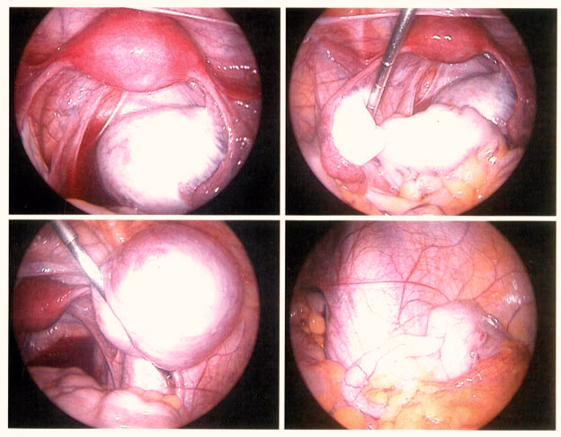 Qu'est-ce que l'endométriose?