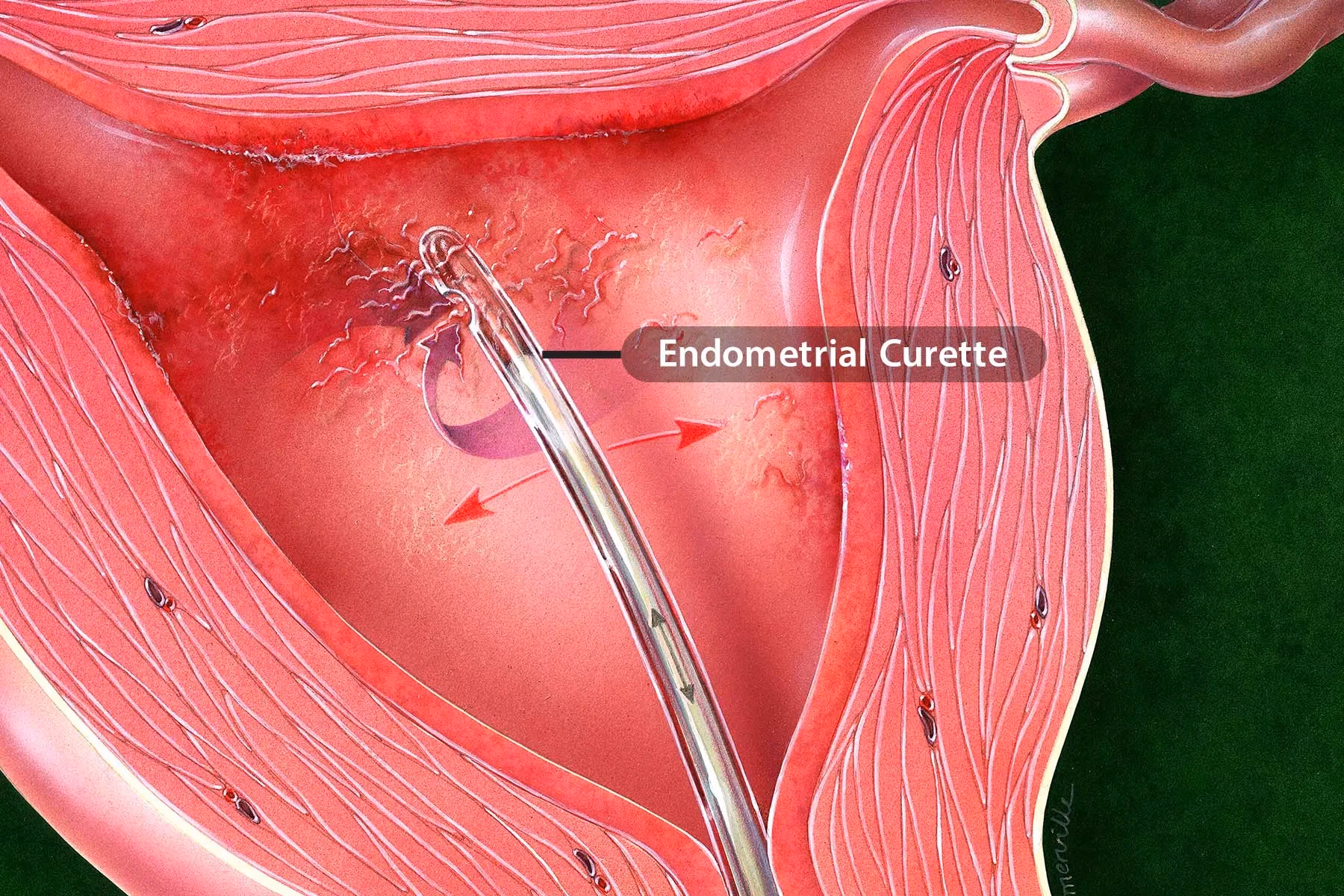 Can dilation & curettage treat endometrial hyperplasia?