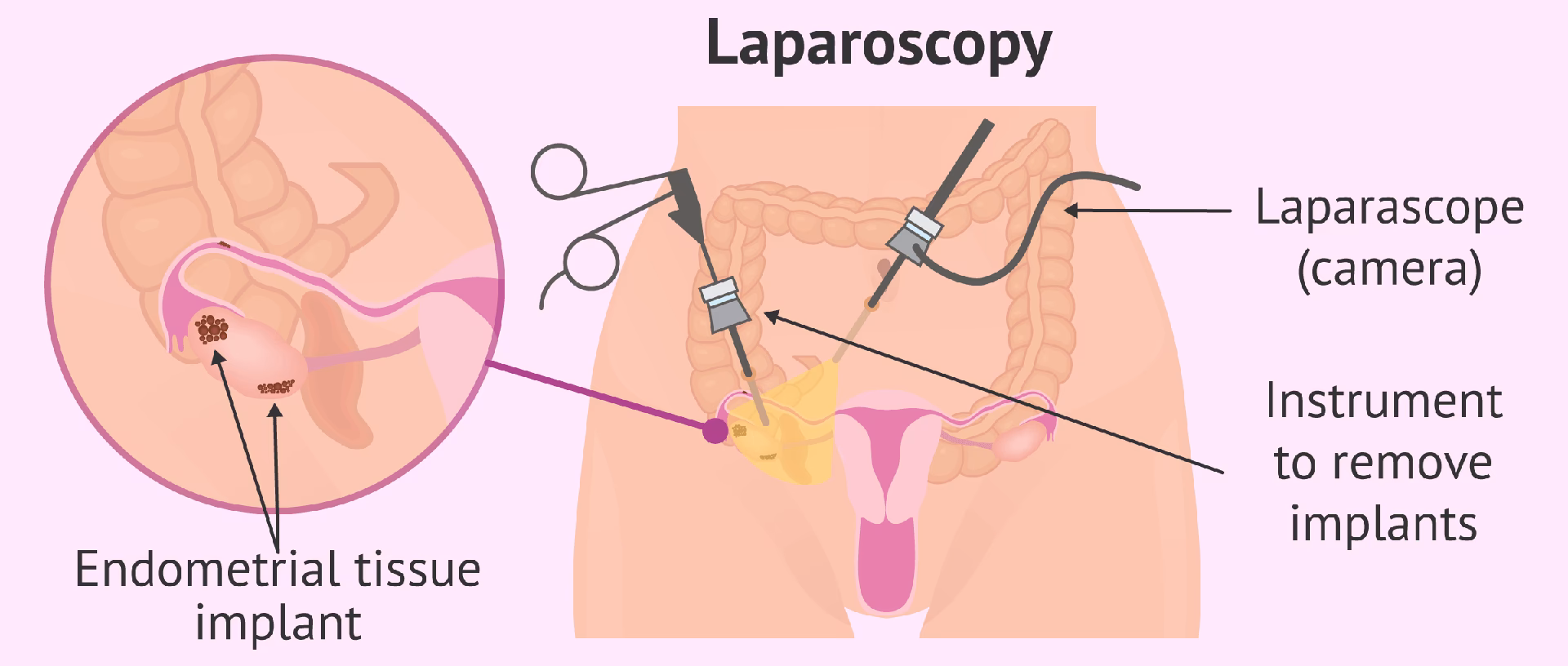 What is an MRI scan for endometriosis?
