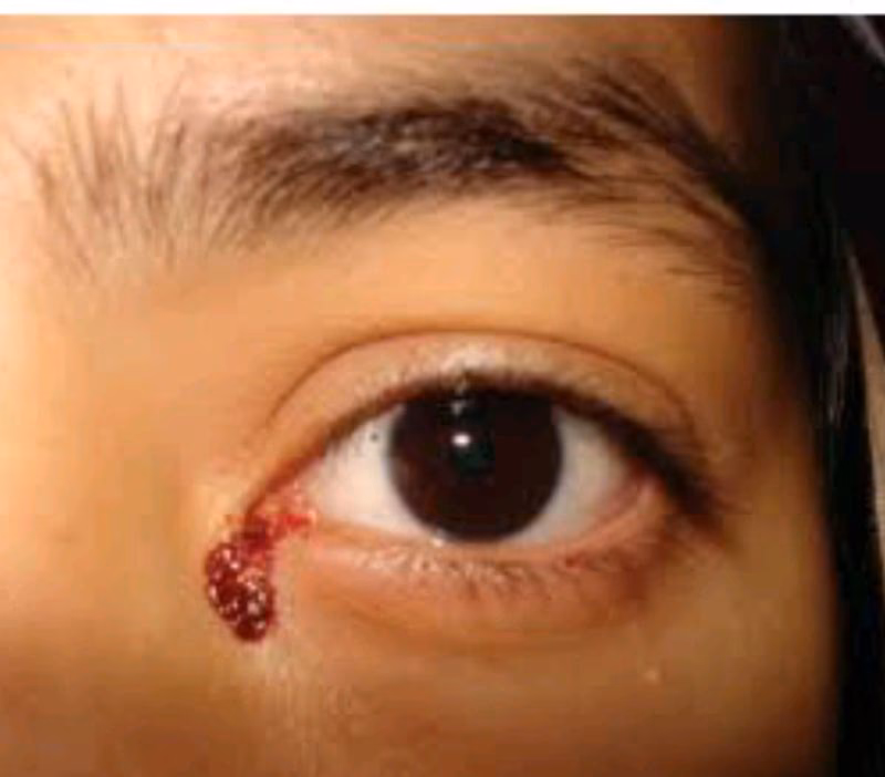 Is there a relationship between eye and endometriosis?