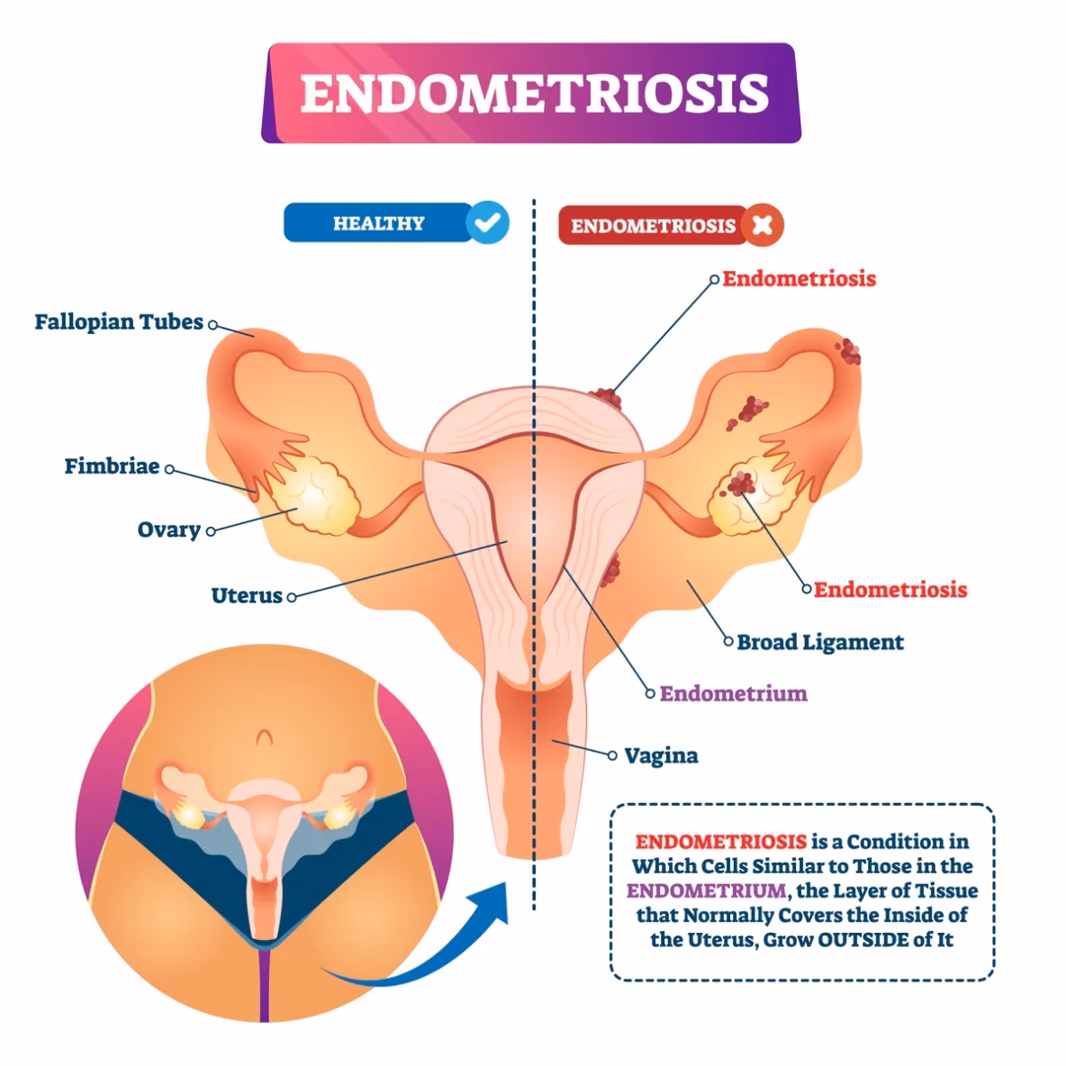 Can endometriosis cause a loss of eggs?