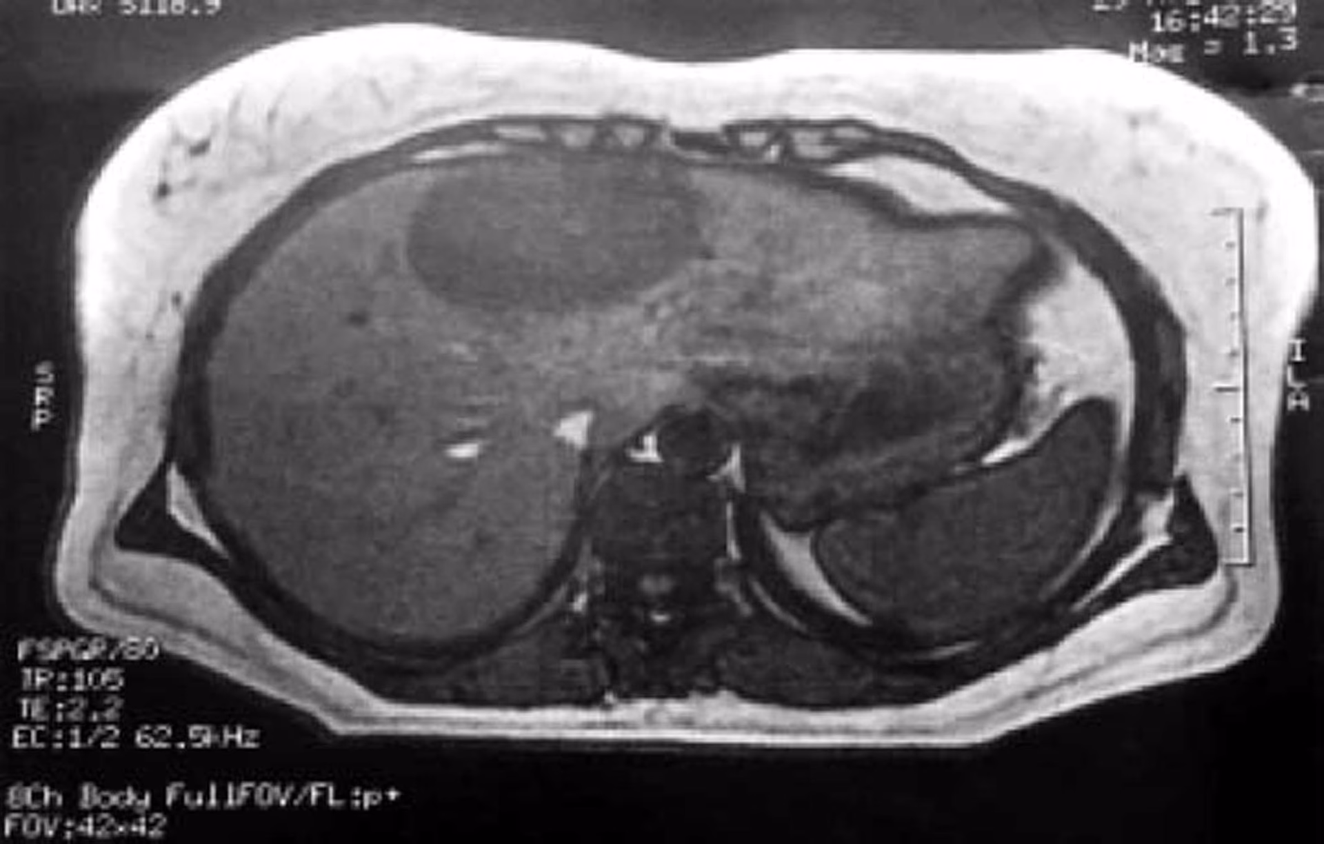 What is hepatic endometriosis?