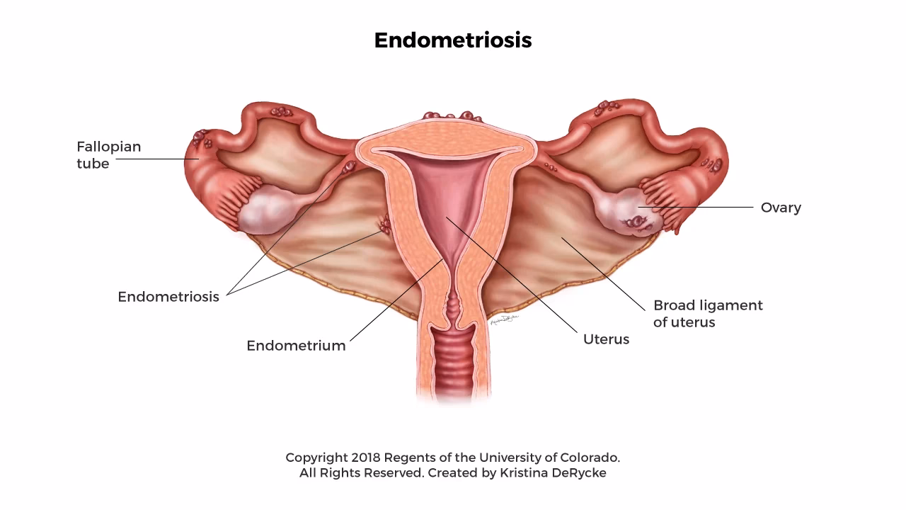 What are the symptoms of endometriosis?