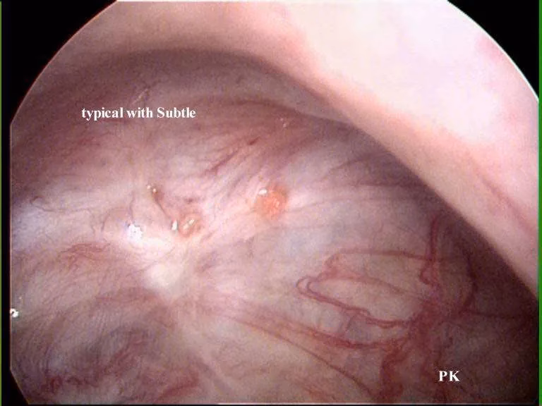 What are the different types of endometriosis lesions?