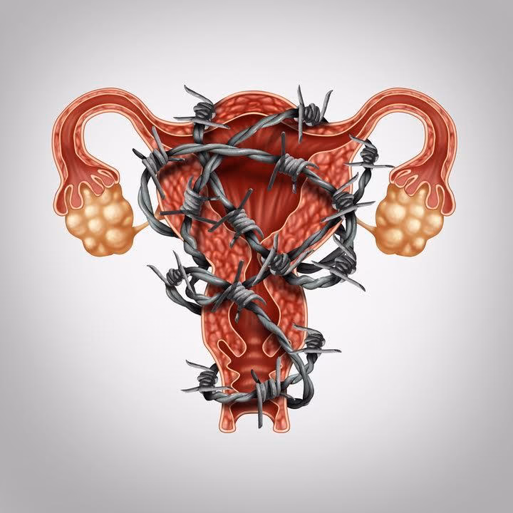 What is Ovarian endometriosis?