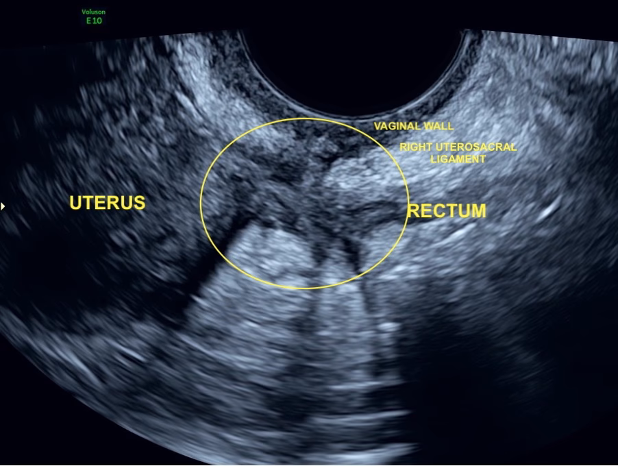 Why is endometriosis missed on ultrasound?