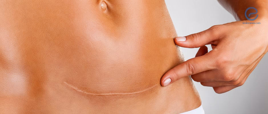 Where does cutaneous endometriosis occur?