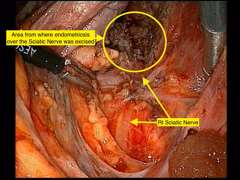 How effective is surgical management of endometriosis affecting somatic nerves?