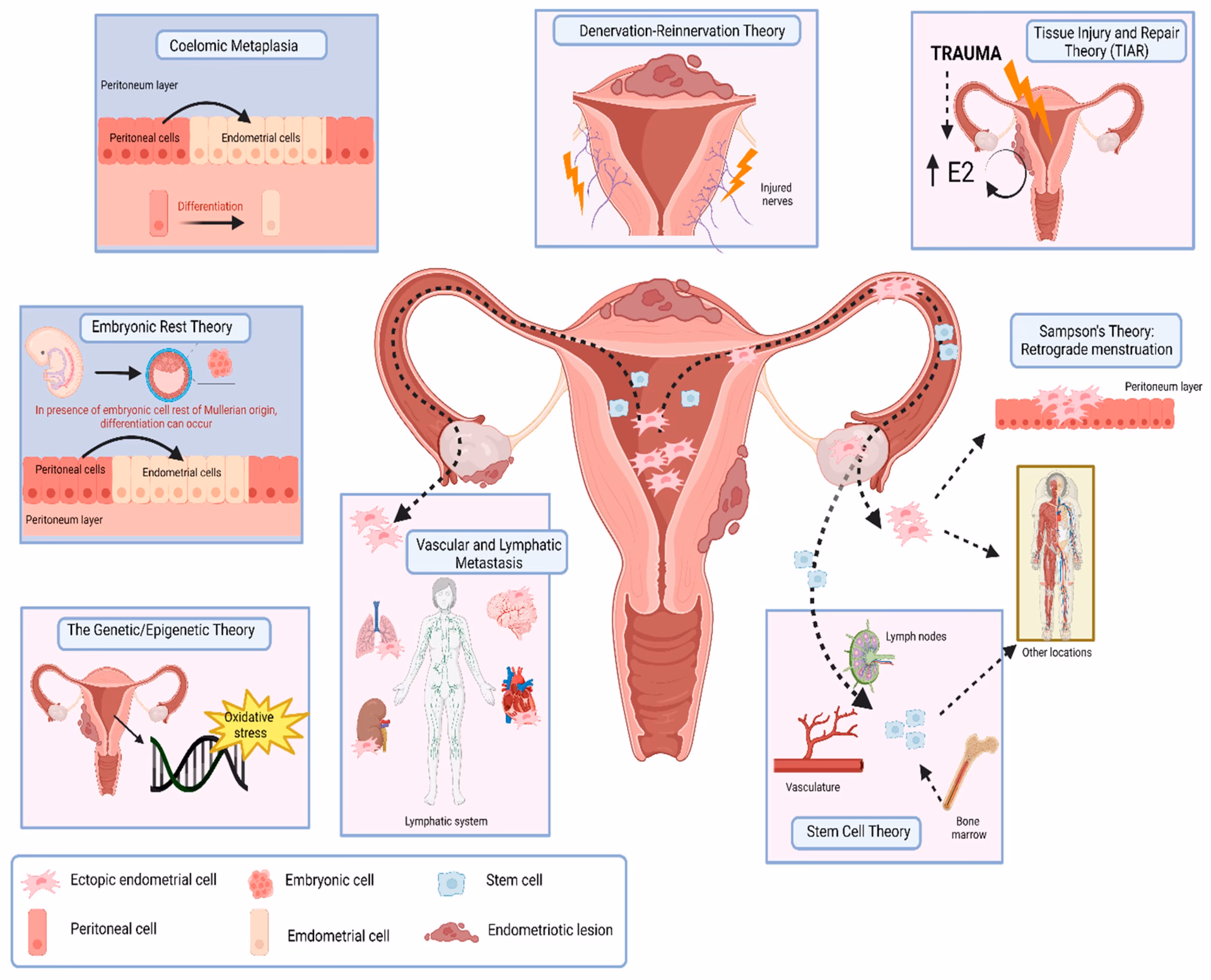 What factors are involved in the pathogenesis of endometriosis?