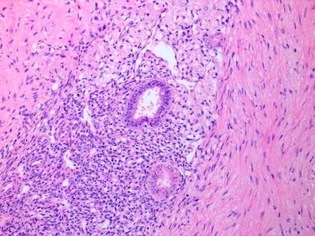 Where does endometriosis occur?