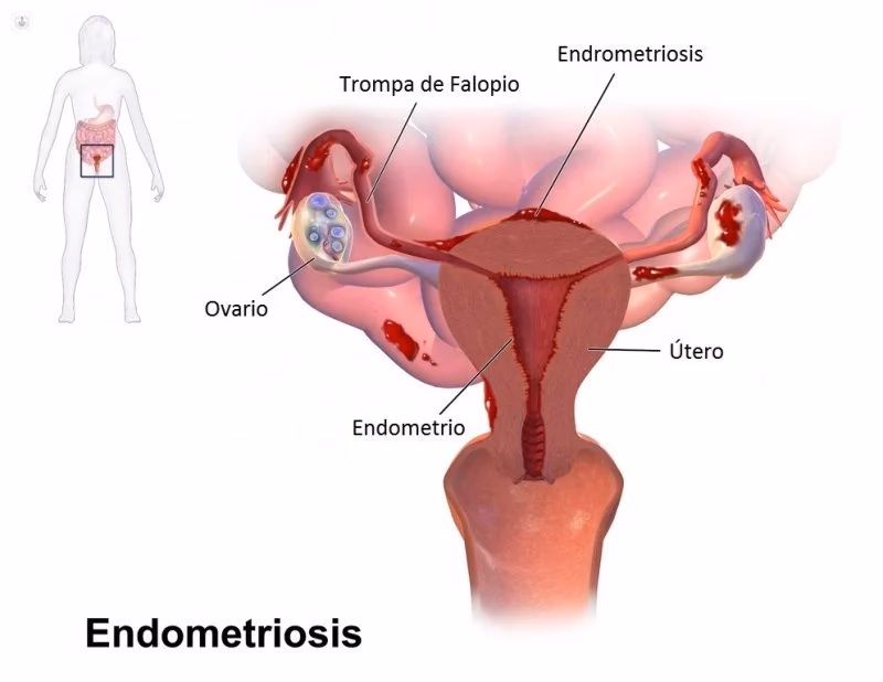 ¿Cuál es el tratamiento quirúrgico de la endometriosis?