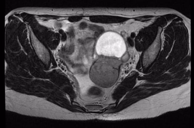 How is deep endometriosis diagnosed?