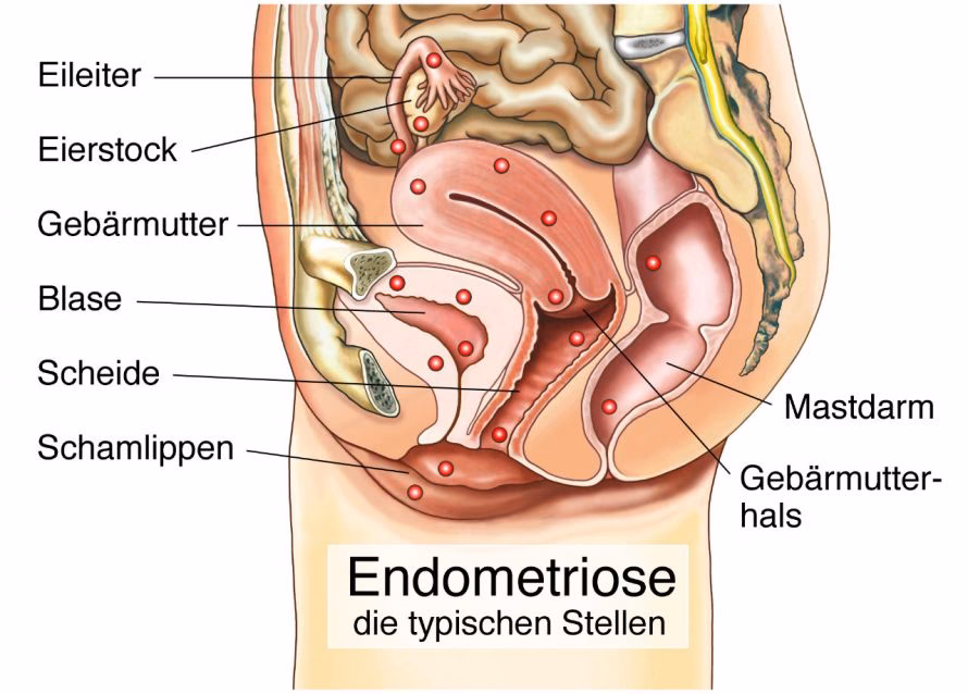 How is endometritis treated?
