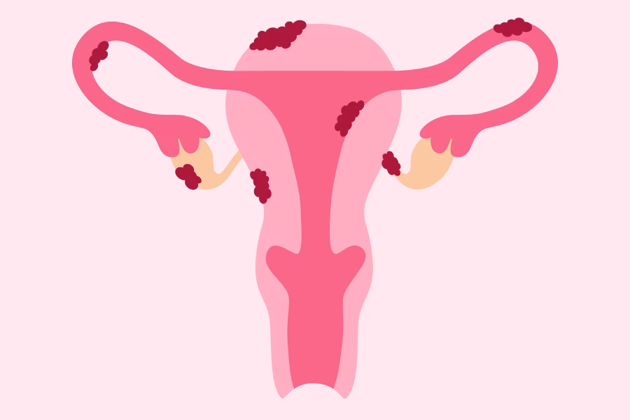 What is the University of Michigan endometriosis center?