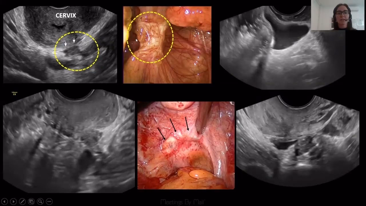 Can laparoscopy diagnose endometriosis?
