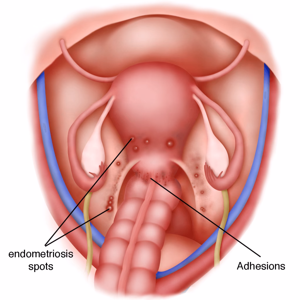 Can uterosacral ligament endometriosis cause infertility?