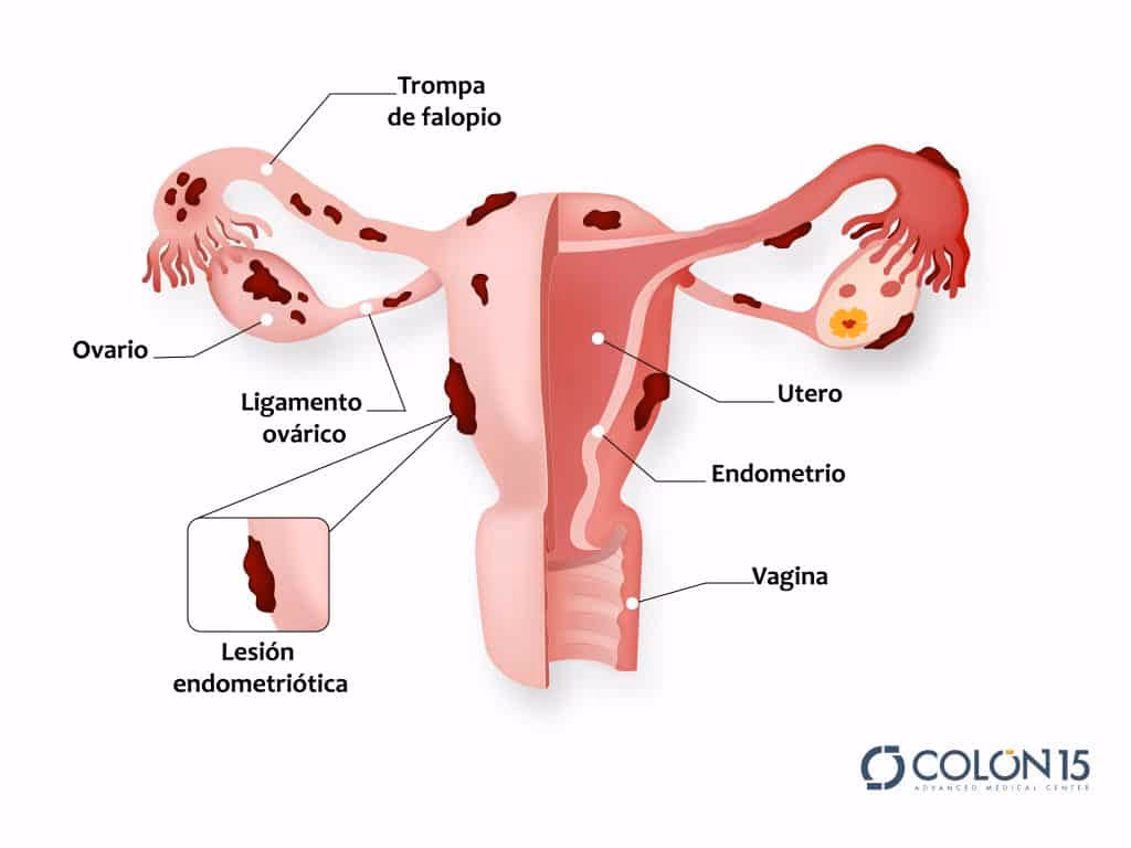 ¿Cómo bajar de peso con endometriosis?