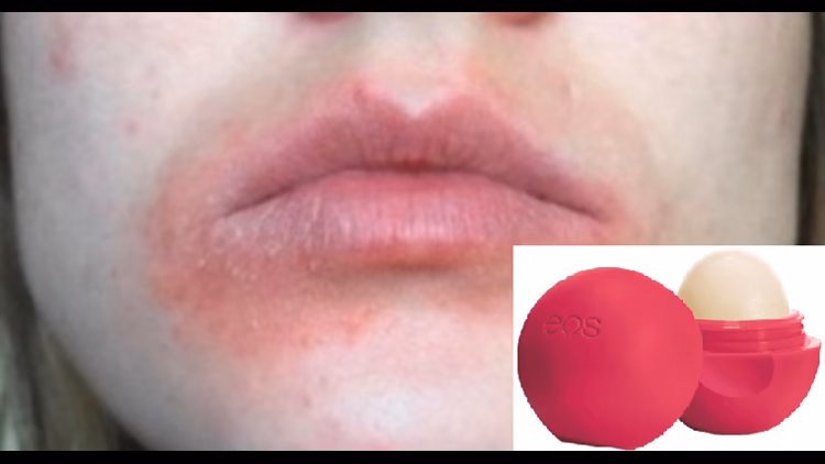 Can lip balms cause allergic reactions?