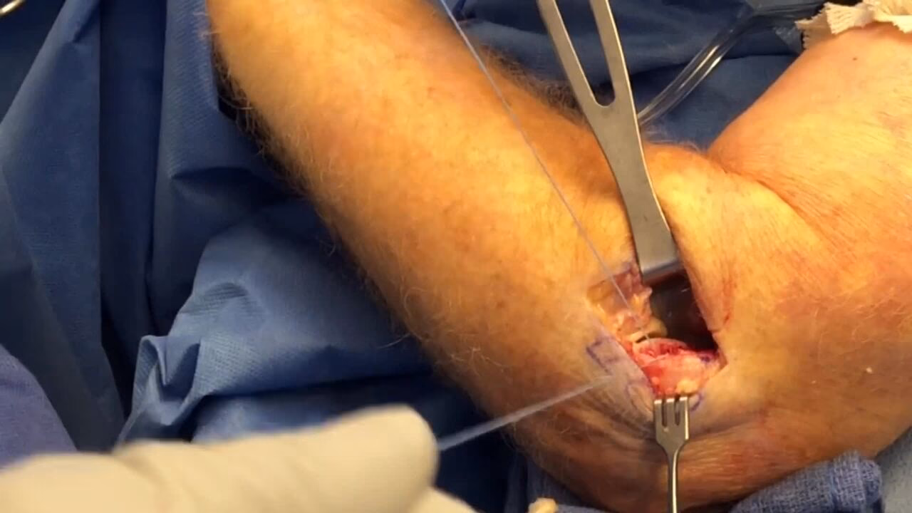 What is tennis elbow & Lateral epicondylitis?