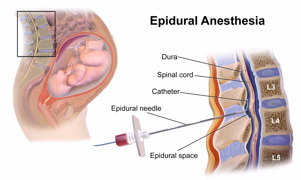 Are epidurals safe during labor & delivery?