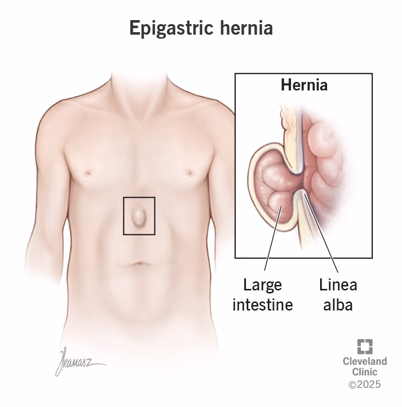 Can epigastric hernia recur after surgery?