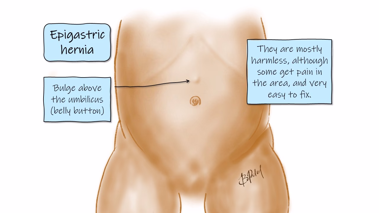 Can an epigastric hernia heal itself?