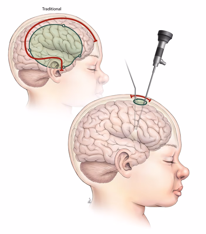 How effective is epilepsy surgery?