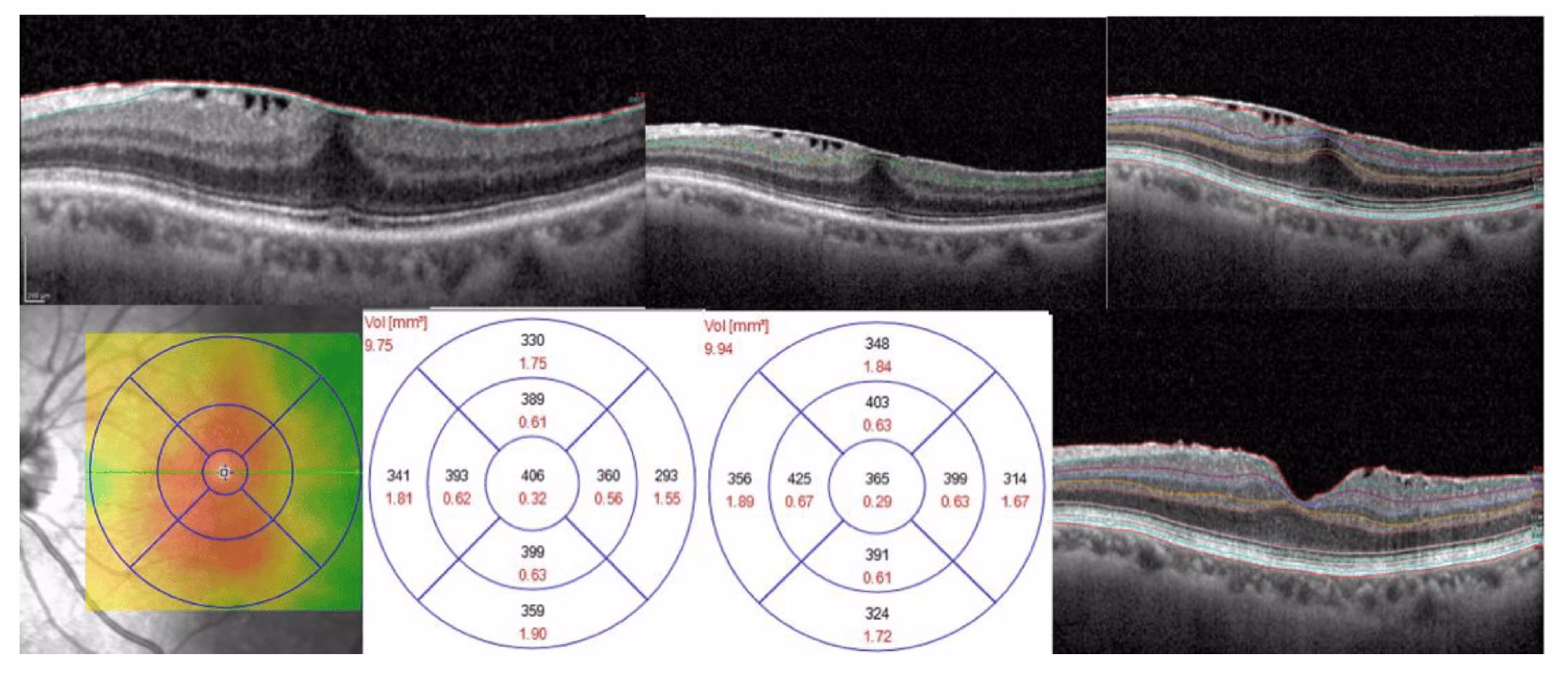 What happens during epiretinal membrane surgery?