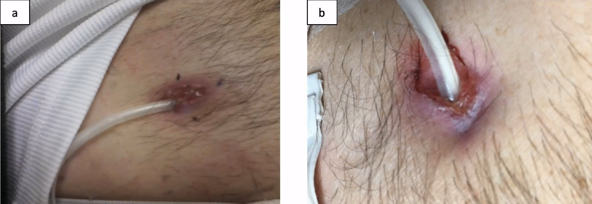 What is an exit-site infection?