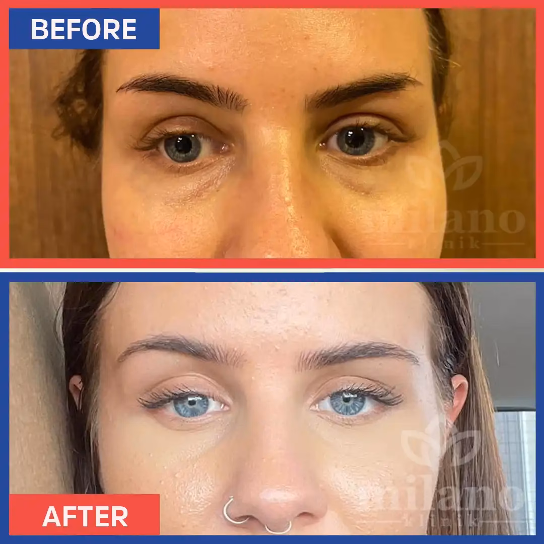 How to prepare for eyelid surgery in Turkey?