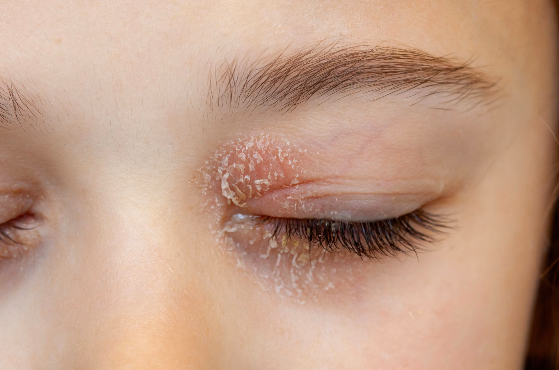 Does eyelid dermatitis hurt?