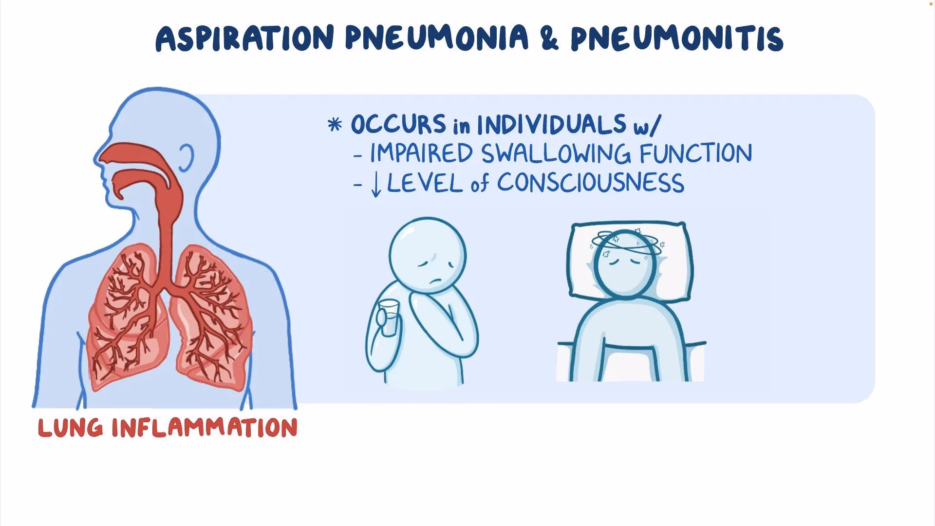 What determines the severity of aspiration pneumonia?