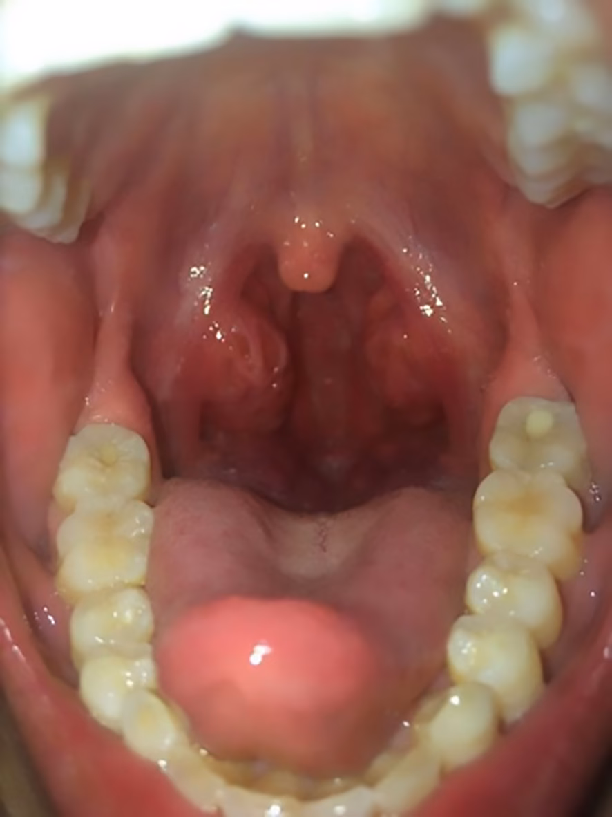 Does Fusobacterium necrophorum cause acute pharyngitis?