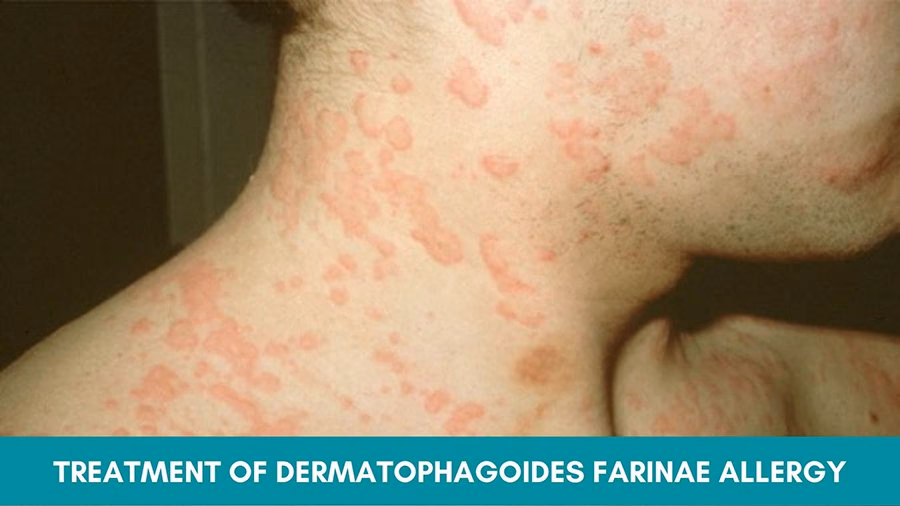 What is immunotherapy for Dermatophagoides farinae allergy?