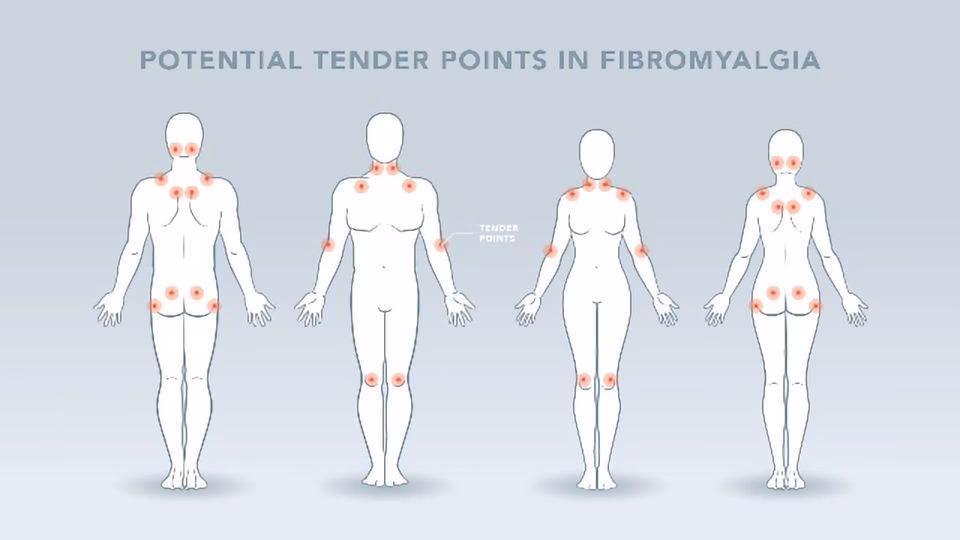Is fibromyalgia a treatable disease?