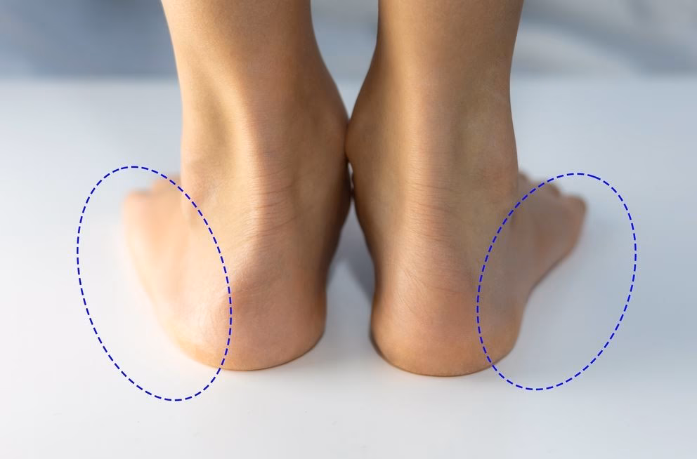 How much does flat feet treatment cost?
