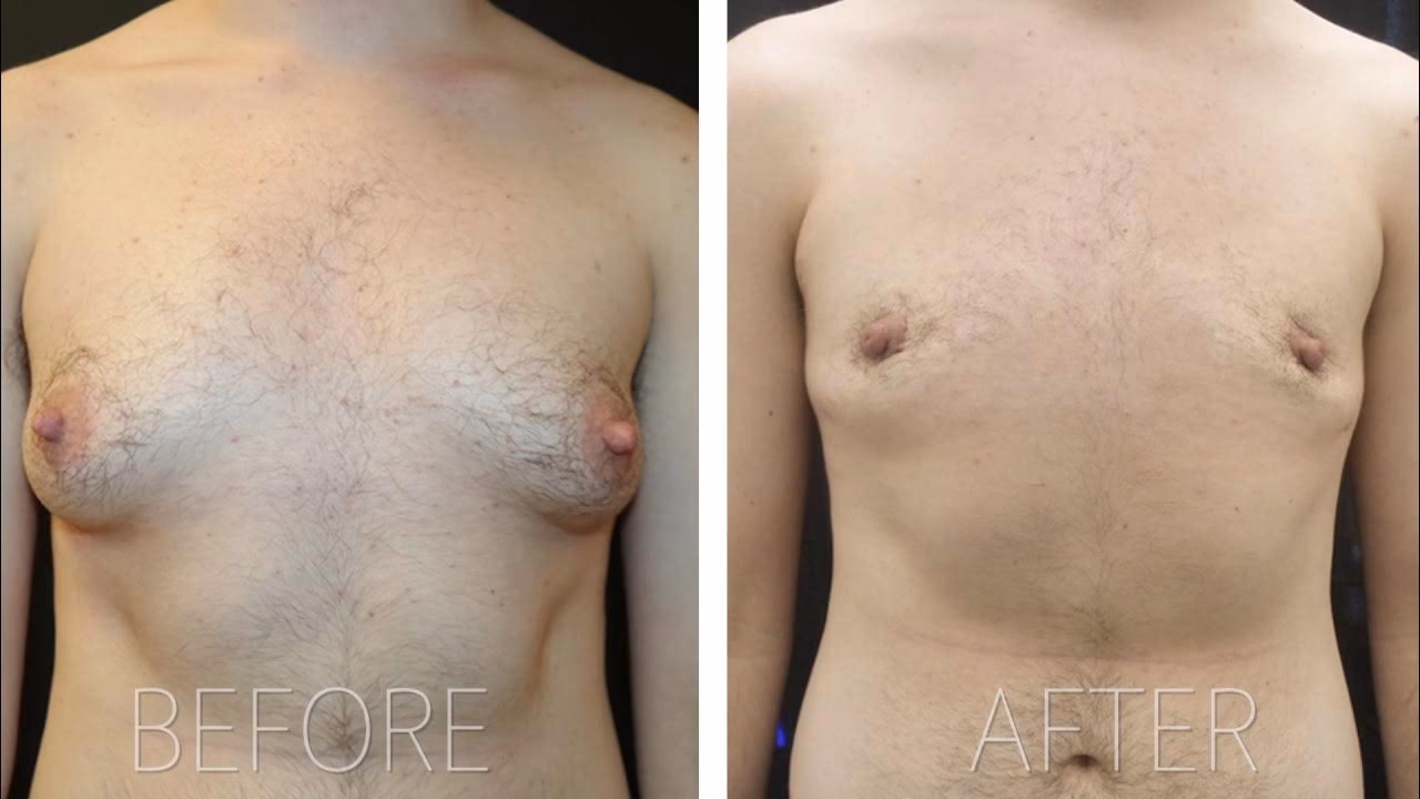 What is a post op female to male surgery period?