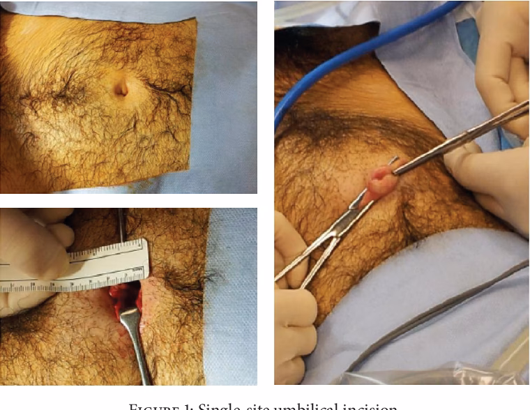 What is female to male surgery?