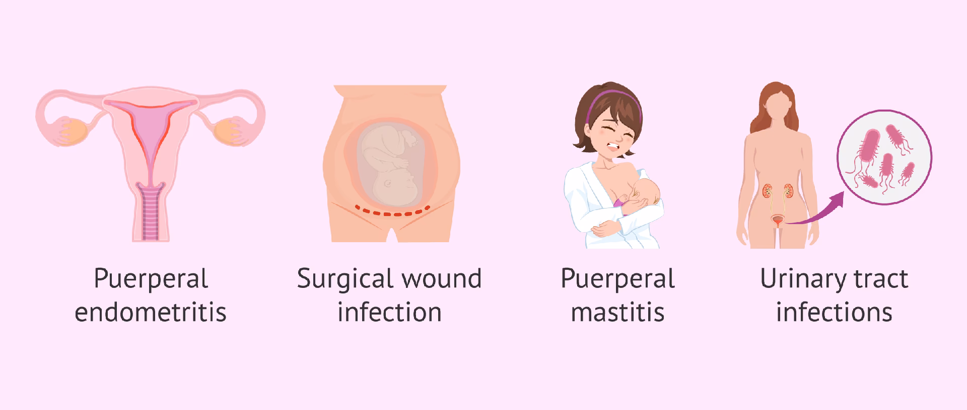 What is a postpartum infection?