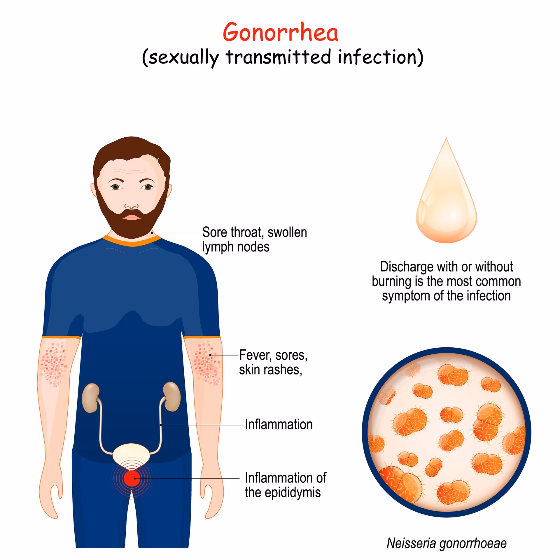 Can gonorrhea cause fever?