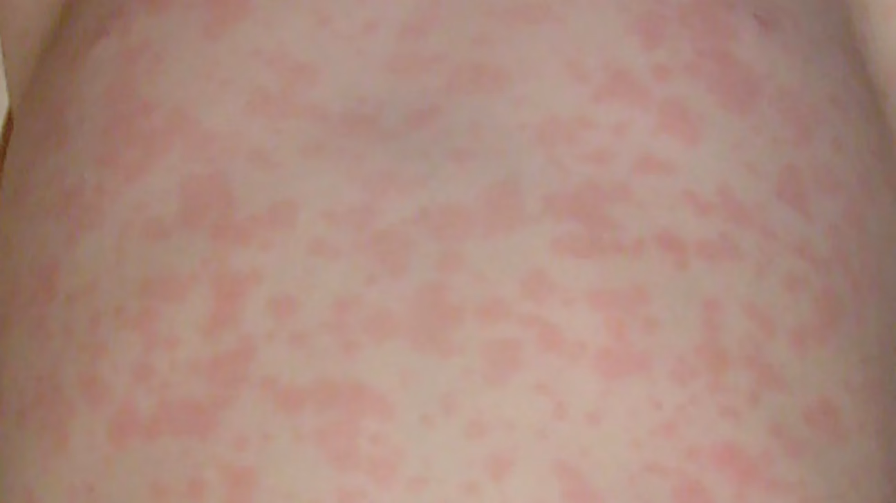 What are the features of a fever rash?