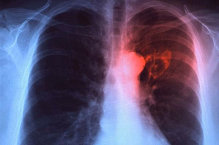 How long does fibromyalgia chest pain last?