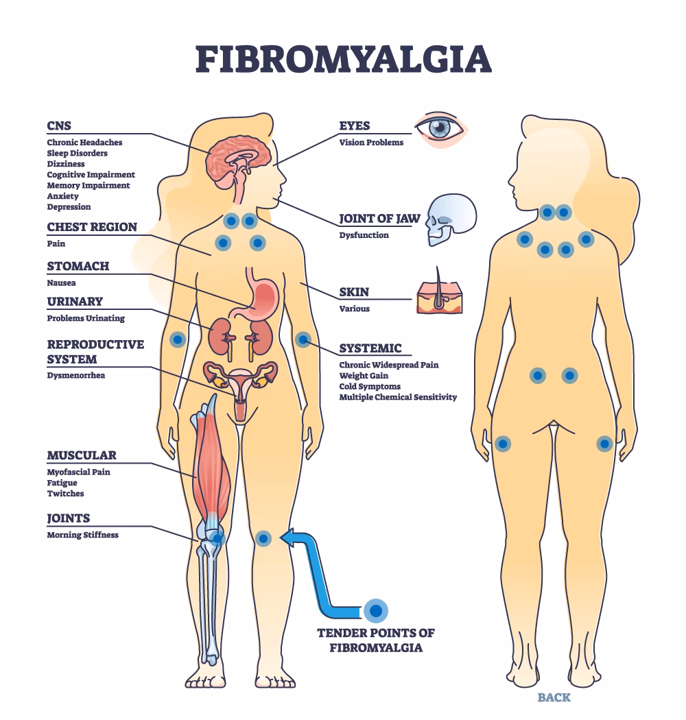 What is fibromyalgia & how does it affect the pelvic floor?