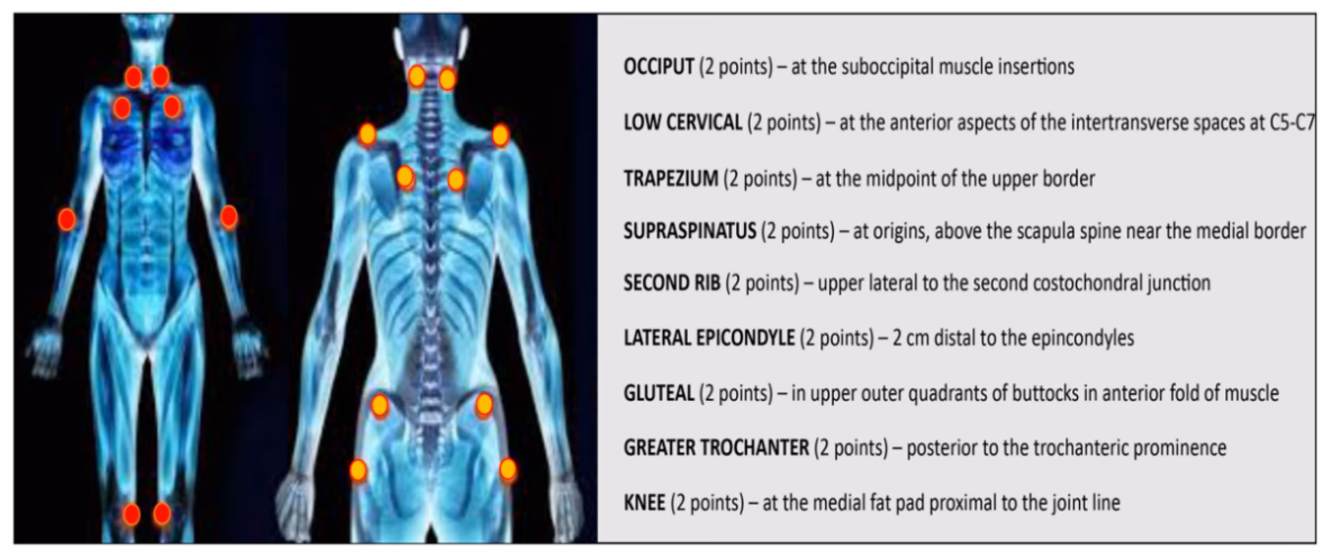 Does insular Glu affect pain report in fibromyalgia patients?