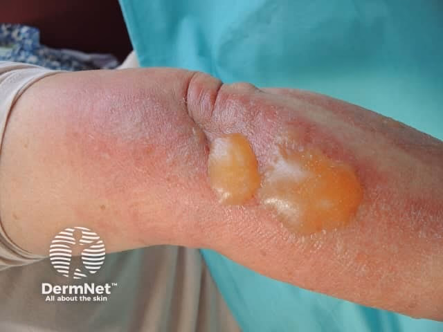 What are the symptoms of a fig allergy?