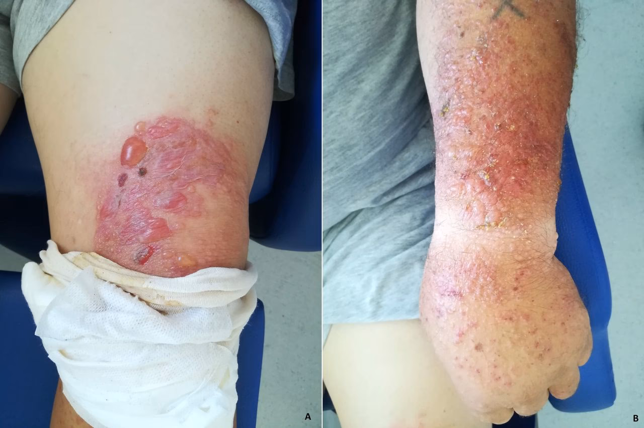 Can you have an allergic reaction to a fig tree?