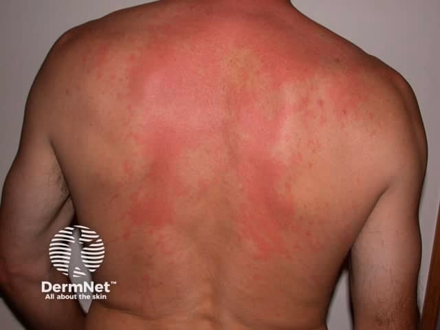 What causes red sores on fish?